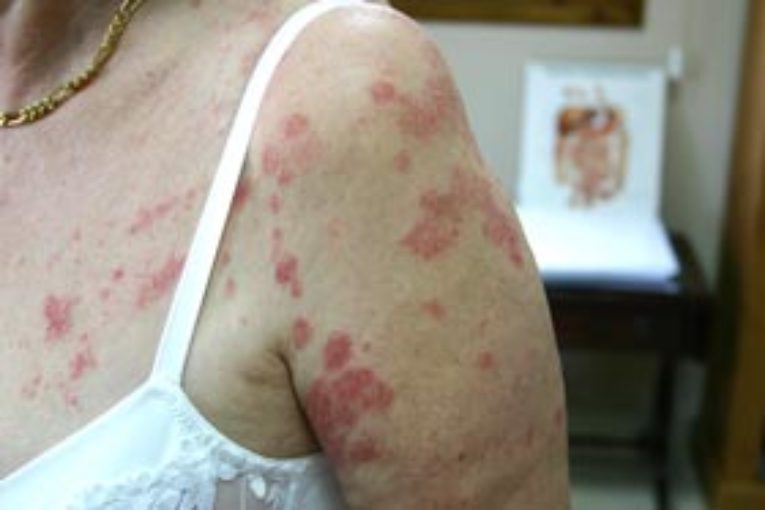 Candida Mantarı Nedir? Belirtileri ve Tedavisi Nelerdir? Nasıl Beslenmeli?