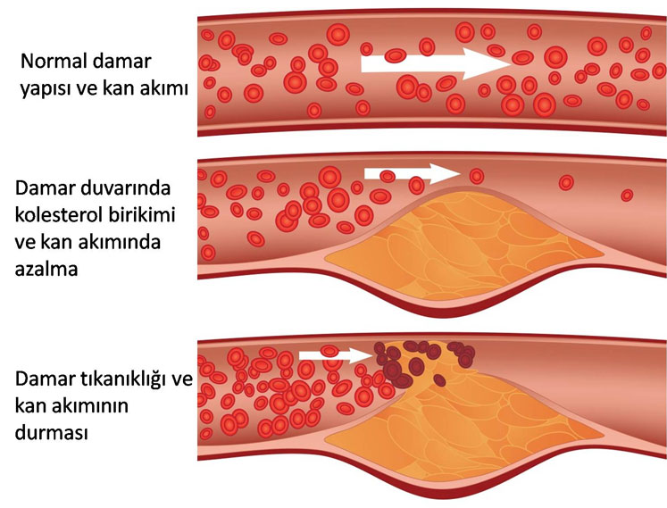 Kolesterol ve damar tıkanıklığı