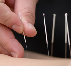 Geleneksel Çin Tıbbı - akupuntur