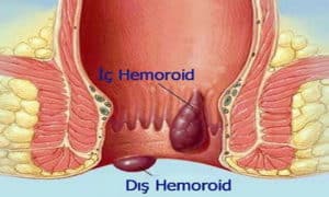 Hemoroid Çeşitleri