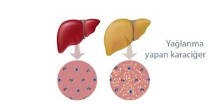 Karaciğer yağlanması