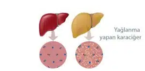 Karaciğer yağlanması