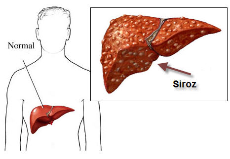 siroz hastalığı