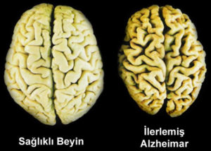 Alzheimer Hastalığı belirtileri