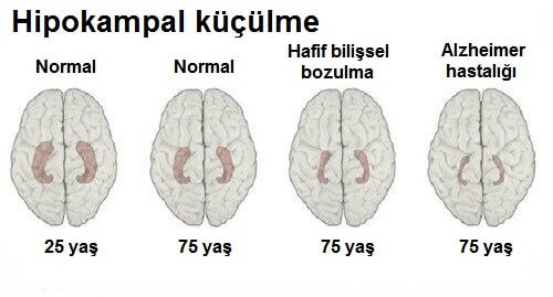 Alzheimer Hastalığı ve yaşlılık