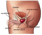 Curcumin prostat kanseri
