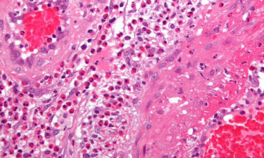 İltihaplanma enflamasyon