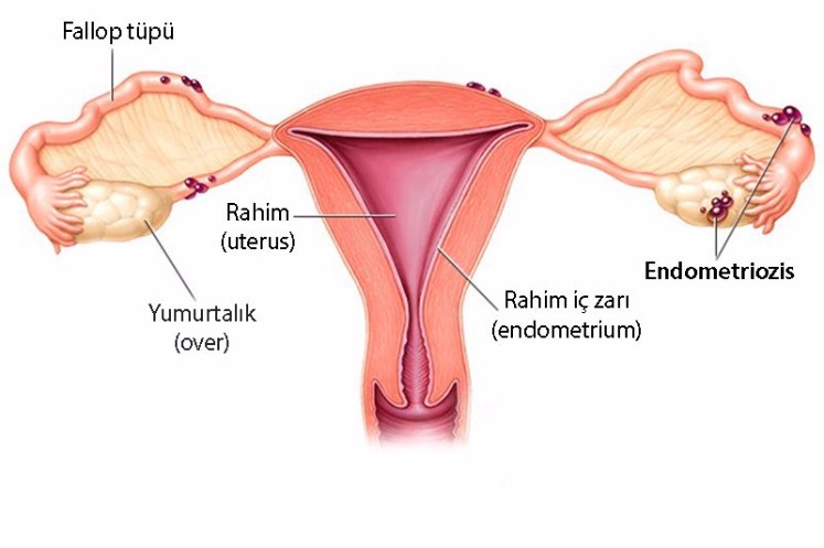 Endometriozis ve Kanser