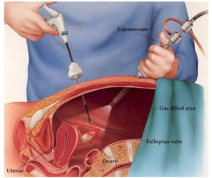 endometriozis ameliyati