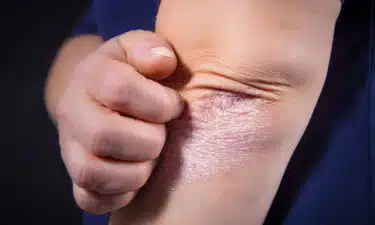 Egzama Nedir? Belirtileri ve Nedenleri? Tedavisi için 13 Doğal Çözüm