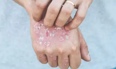 Sedef Hastalığı Nedir? Sedef Hastalığı Belirtileri, Nedenleri ve Tedavileri