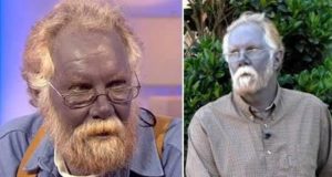 argyria hastası