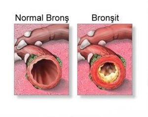 bronşit ve normal bronş