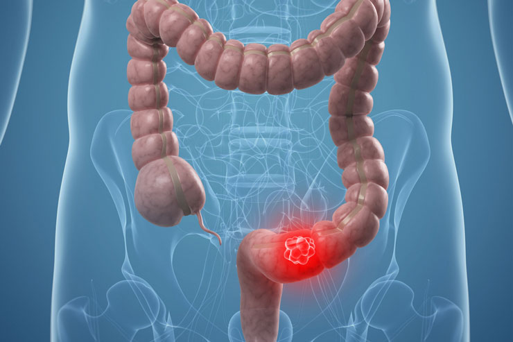 Kolon Kanseri Nedir? Belirtileri ve Tedavisi