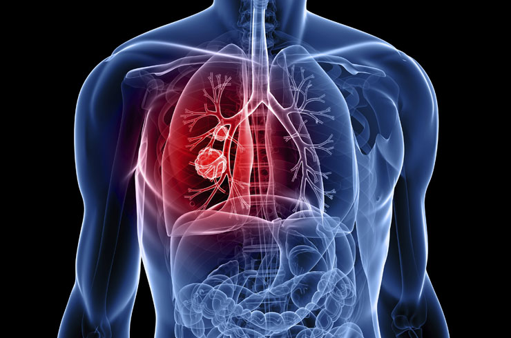 Akciğer Kanseri Nedenleri ve Belirtileri