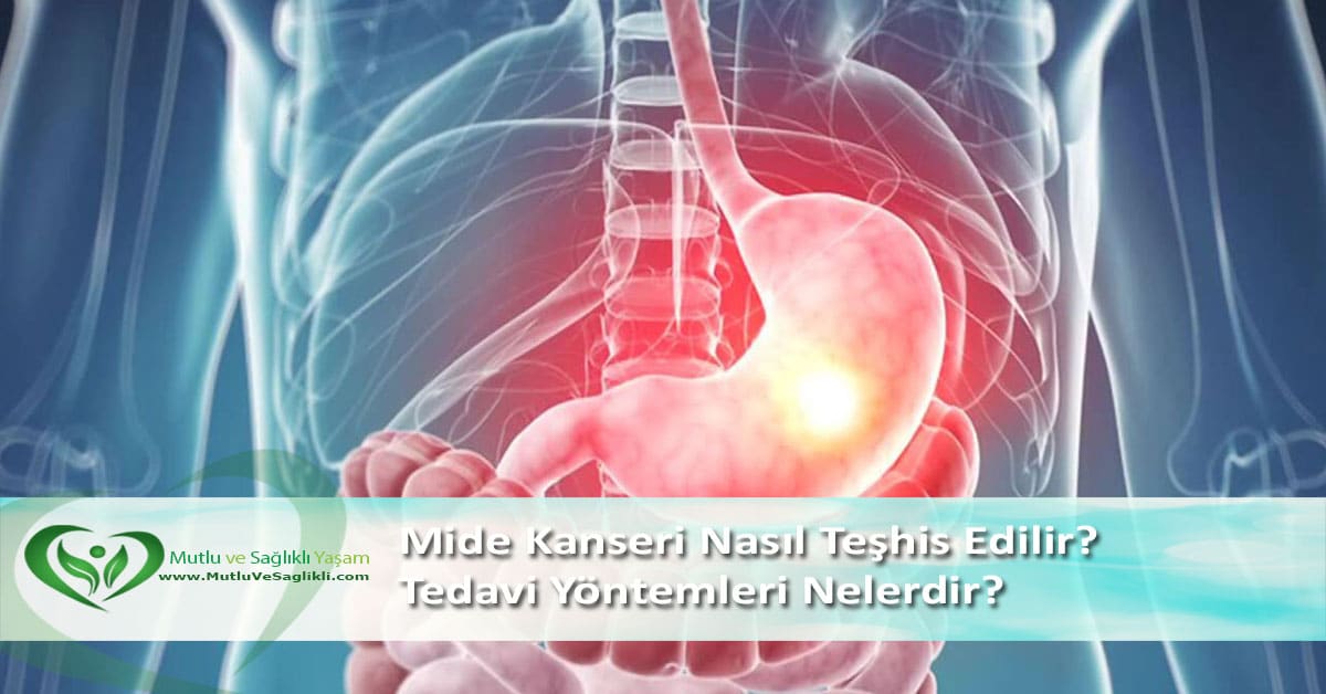 Mide Kanseri Nasıl Teşhis Edilir? Tedavi Yöntemleri Nelerdir? Mide Kanseri Nasıl Teşhis Edilir? Tedavi Yöntemleri Nelerdir?