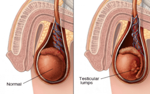 Testis kanseri