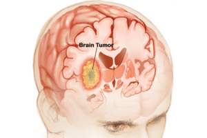 Beyin tümörü