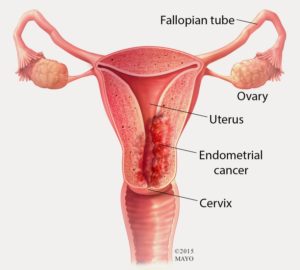 Endometrium kanseri