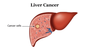Karaciğer kanseri