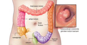 Kolon kanseri