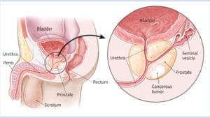 Prostat kanseri
