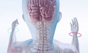 Multipl Skleroz MS Nedir Nedenleri Belirtileri Basa Çikmanin Yollari w