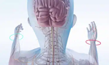 Multipl Skleroz MS Nedir Nedenleri Belirtileri Basa Çikmanin Yollari w