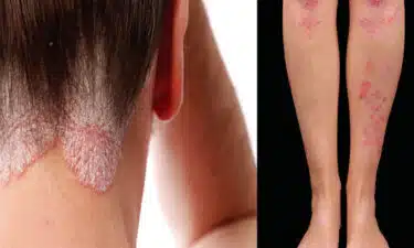 Sedef Hastalığı: Beslenme, Takviyeler ve Kullanılabilir Temel Yağlar