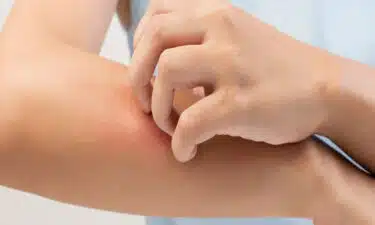 Egzama Hastalığı (Atopik Dermatit) Nedir? Belirtileri ve Nedenleri Nelerdir?