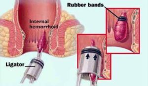 skleroterapi hemoroid