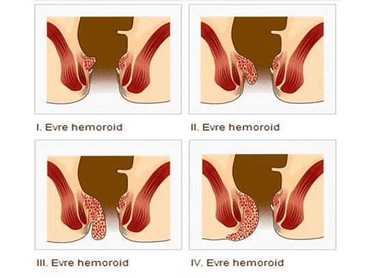 Hemoroid Evreleri