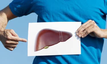 Karaciğer Yağlanması (Hepatik Steatoz) Nedir? Belirtileri ve Tedavisi