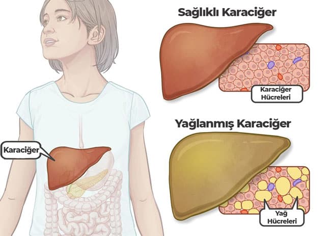 yağlanmış karaciğer ve sağlıklı karaciğer