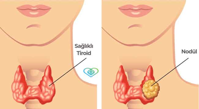 tiroid nodülleri