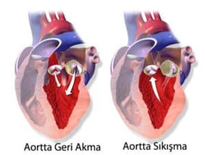 Kalp kapağı hastalıkları Regürjitasyon 