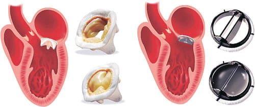Kalp kapağı onarımı, değişimi