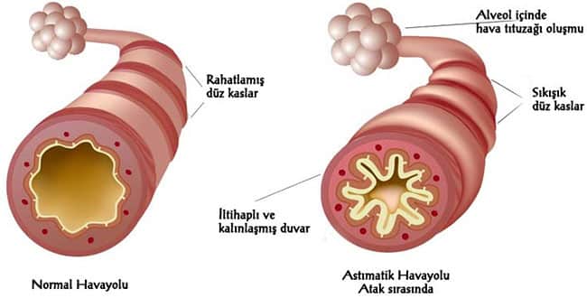 Astım Hastalığı Nedir?