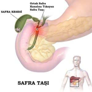 Safra Kesesi Taşı Neden Olur