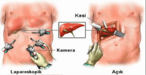 Safra Kesesi Taşı Tedavisi