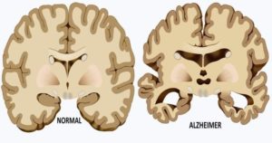 B1 vitamini alzheimer