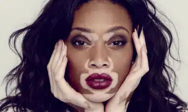 Vitiligo Nedir? Vitiligo Belirtileri ve Tedavi Yöntemleri Nelerdir?