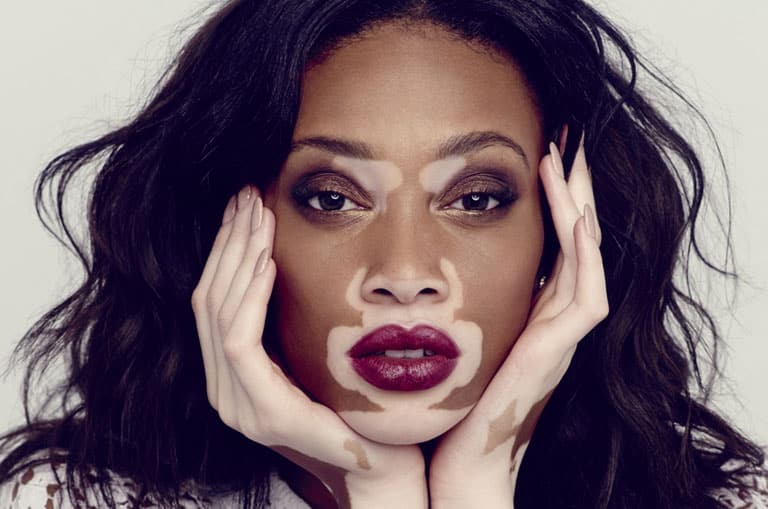 Vitiligo Nedir? Vitiligo Belirtileri ve Tedavi Yöntemleri Nelerdir?