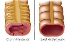 Crohn hastalığı belirtileri