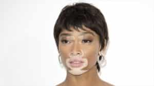 Vitiligo nedir