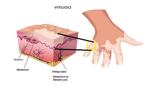 Vitiligo tedavisi