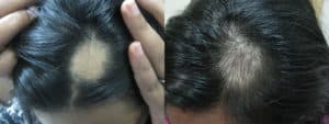 Alopesi areata