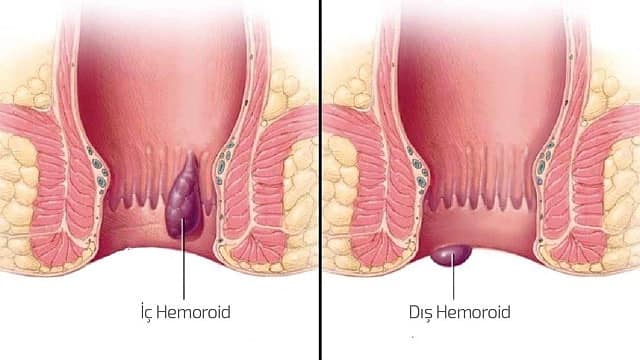 iç hemoroid ve dış hemoroid