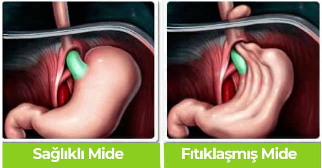 fıtıklaşmış mide