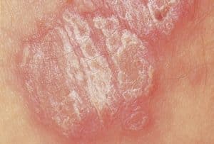 Plaklı Sedef (Psoriasis Vulgaris